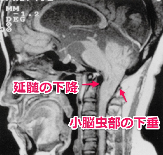 chiari2