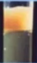 Dyslipidemia1