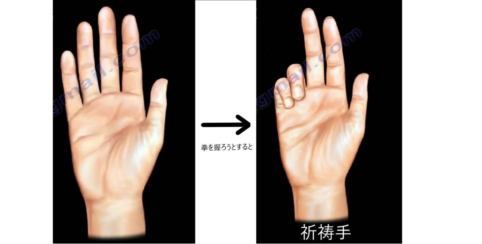 【ゴロ】猿手?鷲手?下垂手?末梢神経障害で出現する手の所見 覚え方 - どすこい研修医