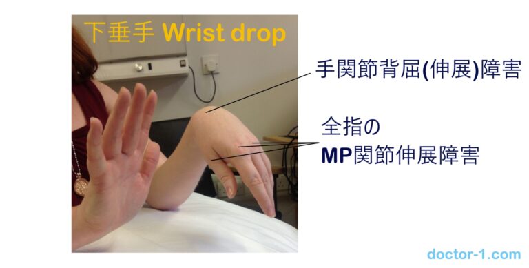 【ゴロ】猿手?鷲手?下垂手?末梢神経障害で出現する手の所見 覚え方 - どすこい研修医